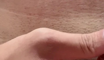 Papaya Seeds Inserted Into the Urethra