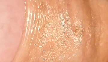 Difficult Fluid Control Due to Straight Phimosis.