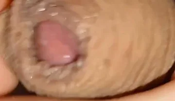 Cumshot of the Largest Phimosis Foreskin in the World.