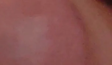 Immense Phimosis Being Extracted Cum and Précum.