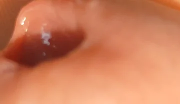 The Great Transformation of Phimosis Elastica.