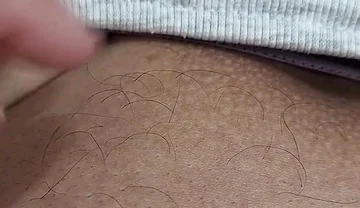 The Hair on My Penis - Led Hair Removal