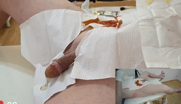 Catheter Insertion