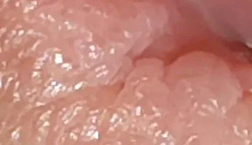 Enlargement of the Deep Urethral Hole!!