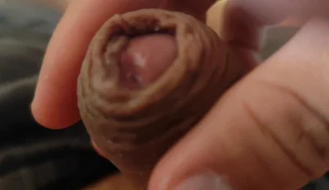 Great Phimosis Getting in the Way of the Boy's Orgasm