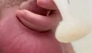 Inflated Ball Sack with Saline