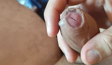 Dilation of the Corpus Cavernosum Exposes Spongy Foreskin.