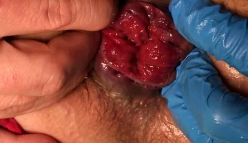 Finger in My Prolapse