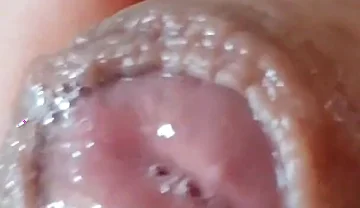 Deep Split in the Glans Produces Bubbling Liquid