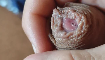 Deep Split in the Glans Produces Bubbling Liquid