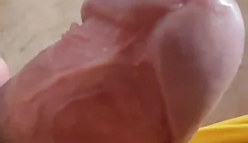 Scarred Frenulum Causes Glans Erection!