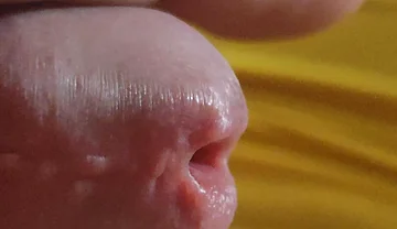 Scarred Frenulum Causes Glans Erection!