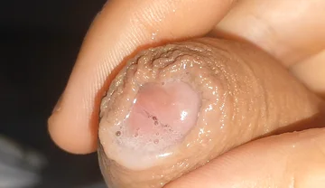 Curious Close-up of Pre-cum in Flaccid Phimosis.