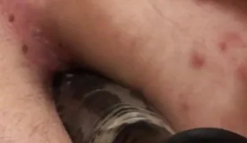 Anal hammer - Gay