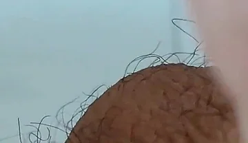 Extreme Open Hole Leaves the Glans Exposed.