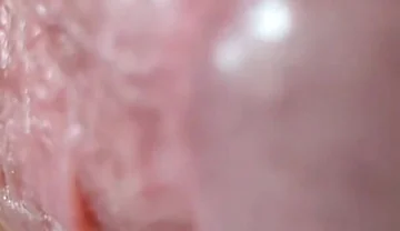 Opening the Scar of the Rough Frenulum!