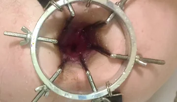 Enema, Anal Shower. Close-up View Through Anal Mirror. Anal with Water. Filling Anal with Water