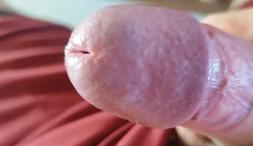 The Blossoming of Extensive Elastic Phimosis.