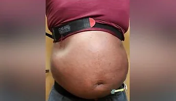 N2o Belly Inflation