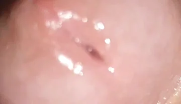 Maximum Dilation of Phimosis Cumming.