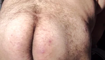 Fat Obese Butt