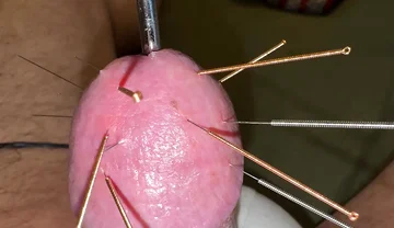Acupuncture - Orgasm!