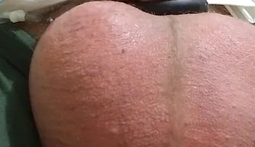 Saline in the Testicles