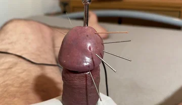 The Best Acupuncture Method!