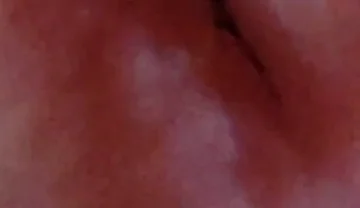 Dilation of the Glans Eye Has a Pleasant Surprise.