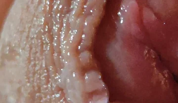 Dilation of the Glans Eye Has a Pleasant Surprise.