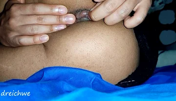 Hemorrhoids in the Ass