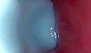 I Couldn’t Believe What Happens Inside the Penis as Sperm Passes Through (endoscopic Footage)