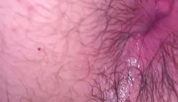 Bruised Asshole