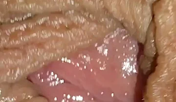 Boy with Large Anal Phimosis Excited!