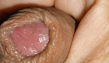 Boy with Large Anal Phimosis Excited!